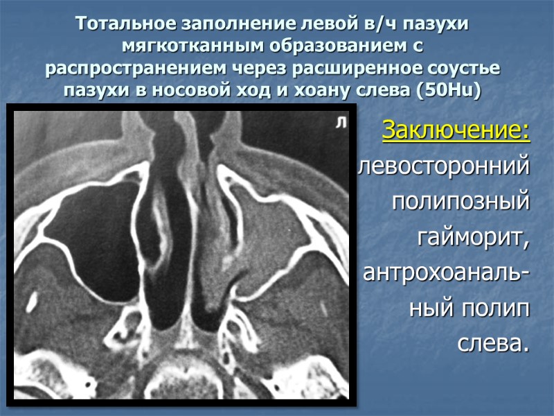 Тотальное заполнение левой в/ч пазухи мягкотканным образованием с распространением через расширенное соустье пазухи в